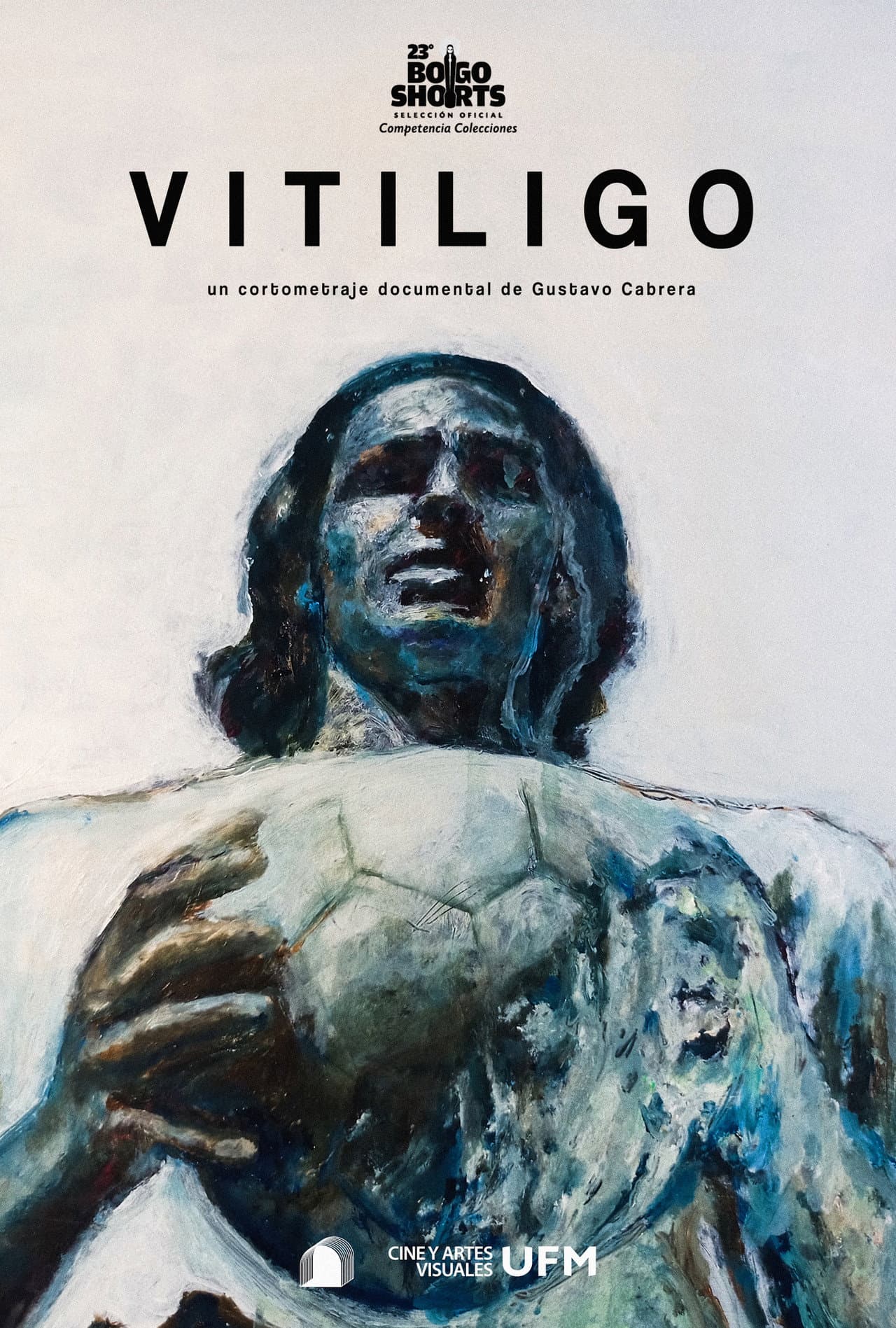 Vitiligo preview 2