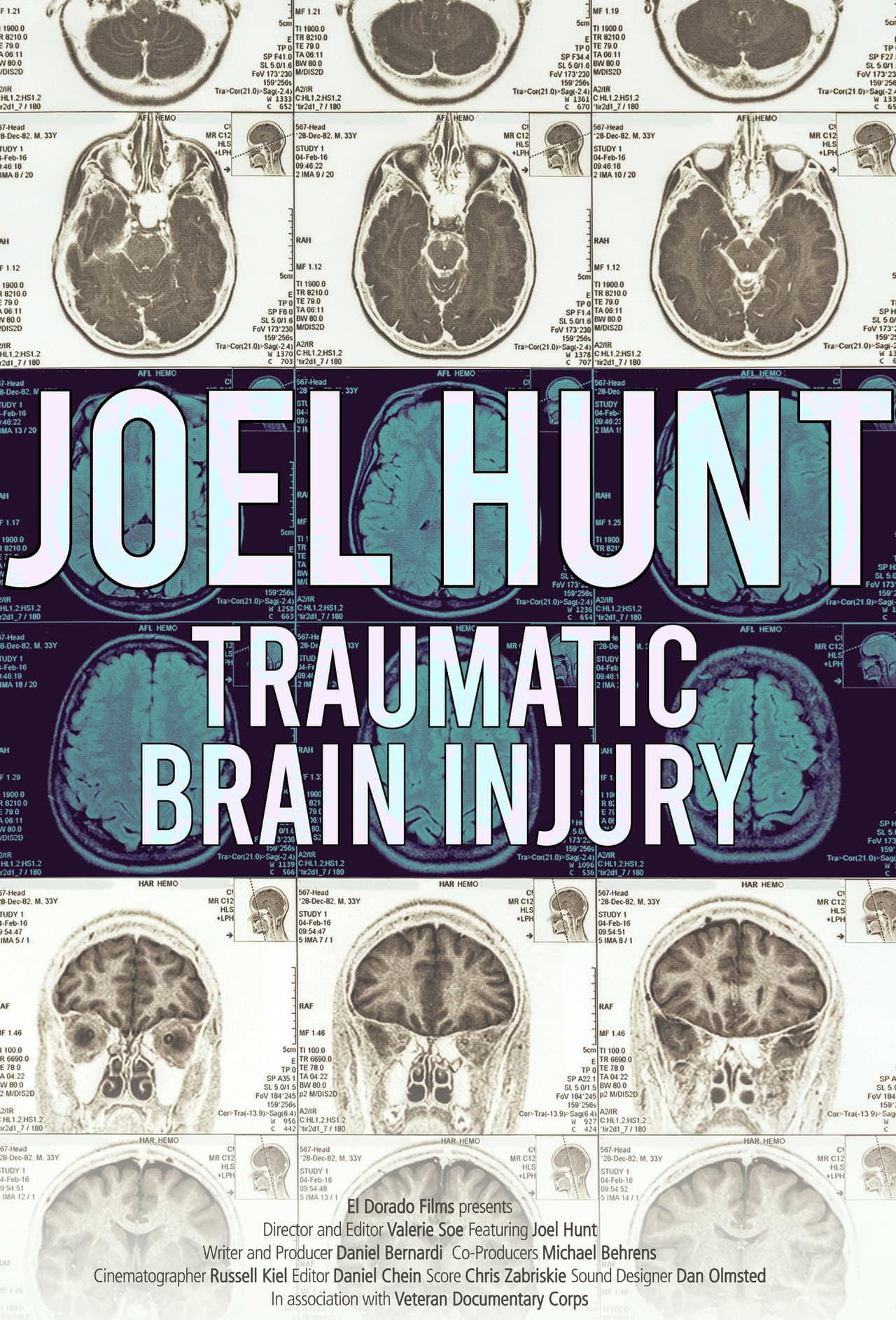 Joel Hunt: Traumatic Brain Injury (TBI) preview 2