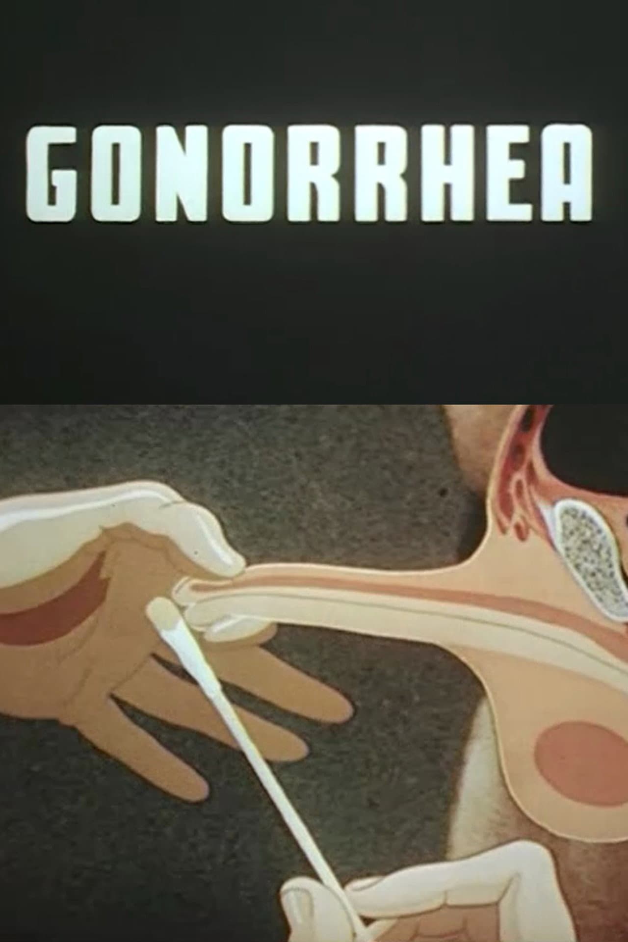 Gonorrhea preview 2