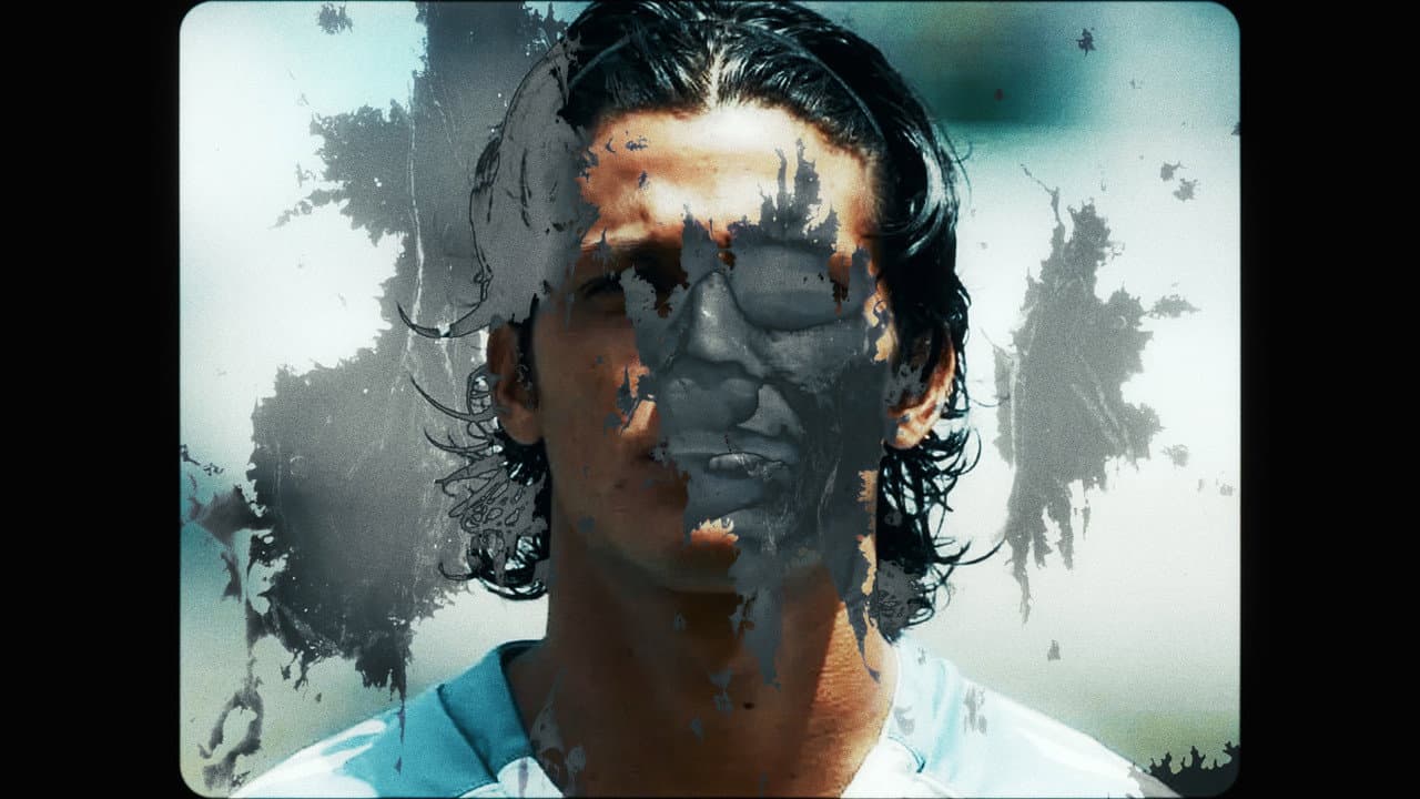 Vitiligo